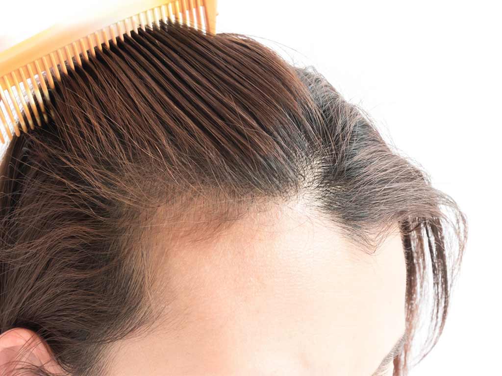 rimedi naturali per contrastare il diradamento dei capelli